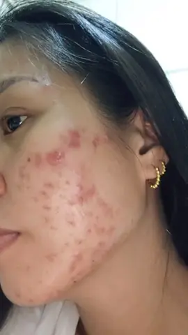 Cetaphil Supremacy!!! gentle skincare for sensitive skin #cetaphil #Cetaphil Toner With Niacinamide #sensitiveskin #acne 