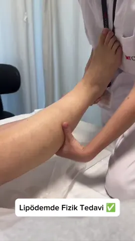 Lipödem tedavisinde fizik tedavi önemli bir rol oynar ve birçok fayda sağlar✅ ✅Fizik tedavi, özellikle manuel lenf drenajı ve kompresyon tedavisi, dokulardaki sıvı birikimini azaltarak şişliği hafifletir. ✅ Özel masaj teknikleri, egzersizler ve kompresyon giysileri, lipödemin neden olduğu ağrı ve hassasiyeti azaltabilir. ✅ Uygulanan egzersiz programları, hareketliliği artırarak hastaların günlük aktivitelerini daha rahat yapmalarına yardımcı olur. ✅ Fizik tedavi yöntemleri, kan ve lenf akışını iyileştirerek yağ dokusunda biriken sıvının dağıtılmasına ve vücuttan atılmasına yardımcı olabilir. ✅ Ciltteki gerilme ve morarma eğilimi lipödemde yaygındır. Fizik tedavi, cilt altındaki sıvı birikimini kontrol ederek bu durumu hafifletebilir. ✅ Lipödem tedavisinde liposuction gibi cerrahi müdahaleler sonrası uygulanan fizik tedavi, iyileşme sürecini hızlandırabilir ve komplikasyonları azaltabilir. Bu tedavi yöntemleri, hastanın yaşam kalitesini artırarak uzun vadeli iyileşme sağlar. ✅  Ücretsiz fizik tedavi hizmetlerimizden faydalanmak için bizimle iletişime geçebilirsiniz. ☎0531 465 69 34   #fiziktedavi #fizikrehabilitasyon #felç #inme #yatılıfiziktedavi