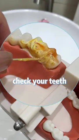 Check your teeth#foryou #fyp #tiktokmademebuyit #tiktokfinds #teeth  #tooth #toothache #waterflosser #clean #personal #nursing #TikTokPromote 