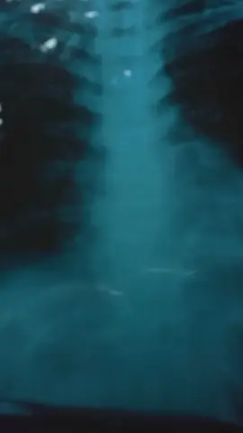 #CapCut #fyppppppppppppppppppppppp #viralvideo #fypシ hasil ronsen paru