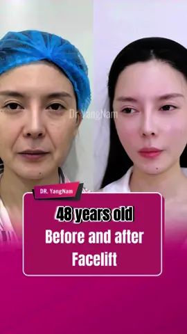 48 years old before and after facelift #facelift #comesticsurgery #indonesia #tiktokindonesia #malaysia #dryangnam #fybシ 