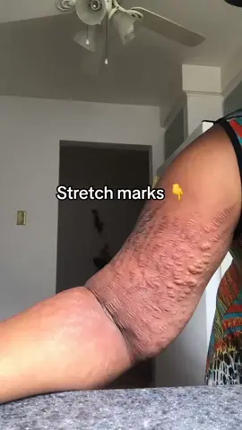 how to treat stretch marks using peeling oil. #stretchmarks #skincare 