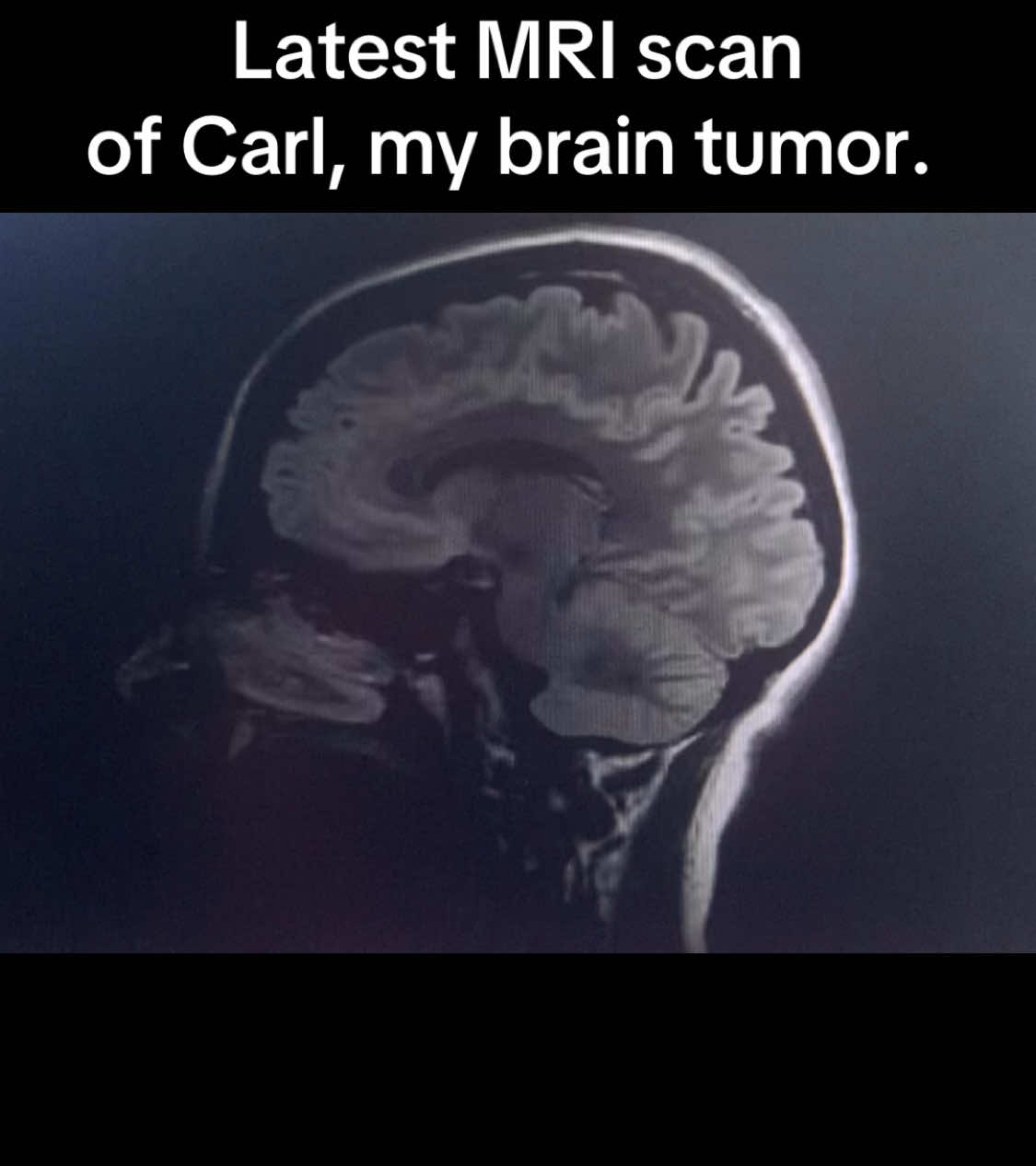 Latest MRI of my brian tumor named Carl. He’s getting evicted 10/25.  #brain #tumor #braintumor #surgerytiktok #surgerytiktok #giloma #cancersucks #mri #doctor 