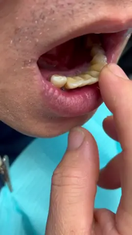 I bet you've never used a toothpaste this effective – Hotluck Hydroxyapatite Toothpaste。