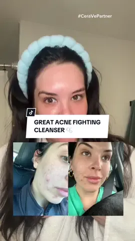 My cheat code to clear glass skin with the @CeraVe acne 10% foaming cream wash!  #ceravepartner #clearituplikeaderm #ceravecleanser #acne #acneproneskin #acnecleanser #acnejourney #howtogetridofacne #howtoclearacne #acnesafecleanser 