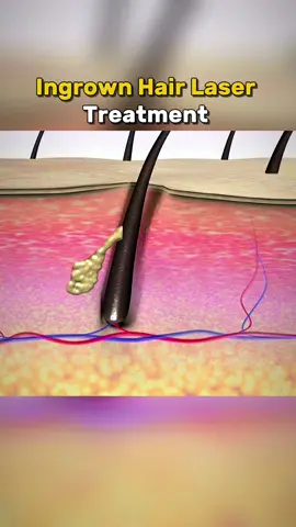 Ingrown Hair  Laser Treatment (ASMR 3D Animation) #ingrownhairtreatment #ingrownhair #medicalanimation #asmrsounds 