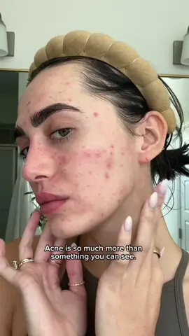 World mental health day + acne 🥺 #acnejourney #acnefighter #acnetips #MentalHealth #worldmentalhealthday 