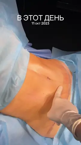 #abdominoplasty #abdominoplastia #абдоминопластика 