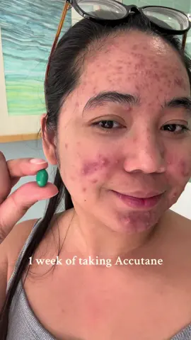 My skin & lips are getting dry #acne #acnejourney #acnetreatment #accutanejourney #isotretinoinjourney #fypシ 