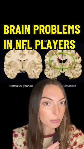 Replying to @lovekelinda CTE is so scary🥺 #cte #tbi #nfl #conspiracy 