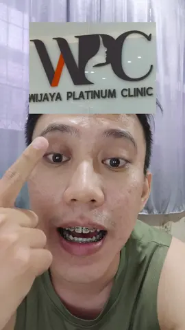 Siapa yg sudah tahu?? kalau ada launching wpc d bandung??? ni aku bantu tag akunnya @wpc.signature silahkan tanyain lokasi tempatnya d mana ya... selamat treatment #treatment #bopeng #scar #klinikkecantikan 