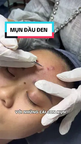 Cách xử lý mụn đầu đen #spa #tiktok #lamdep #hocnghespa #mụn 