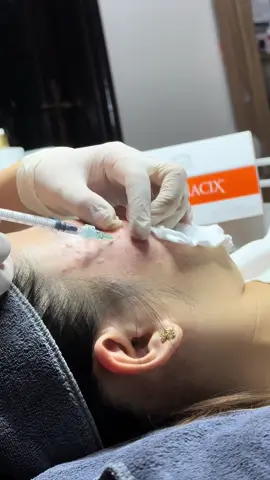 💉 nám tranacix Pháp dòng 💉 ít buốt hiệu quả tốt, hỗ trợ tách lẻ 1 ống cho chị em #dieutrinamtannhang #dieutrinamda 