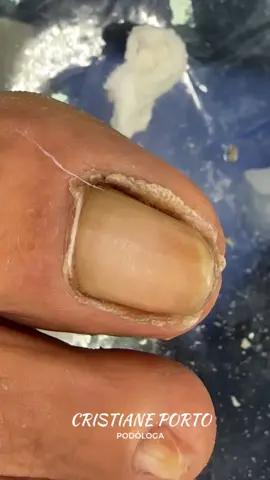 🤤| O VÍDEO MAIS SATISFATÓRIO DO TIKTOK . #peeling #satisfatório #fyp #satisfyingvideo #dormir 