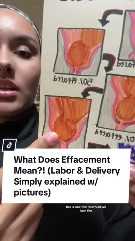 Effacement meaning (what does it mean to be fully effaced?) ✨ #laboranddelivery #pregnanttiktok #pregnant 
