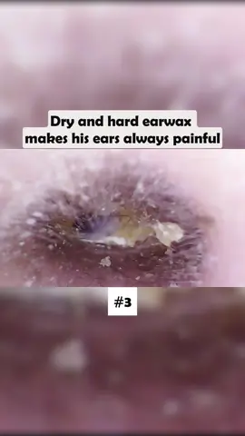 Dry and hard earwax makes his ears always painful Part 3 #earwax #ear #earwaxing #fyp #foryou #asmr #earwash #earcleaning #earwaxcleaner #foreignbodyremoval #doctors #earwaxremoval #removing #earcleaningasmr #washing #relaxingvideos #dry 