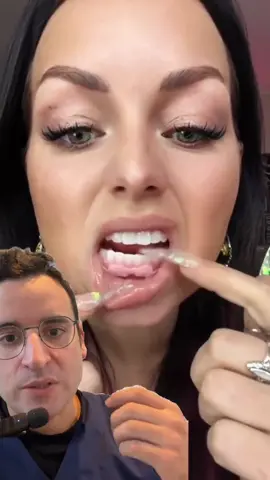 Rebasage des prothèses amovibles : comment améliorer confort et durabilité ? Lorsqu’un patient nous interroge : « Ma prothèse bouge et me fait mal, est-ce normal ? Dois-je en faire fabriquer une nouvelle ? », on réalise l’importance du rebasage des prothèses amovibles pour restaurer leur adaptation et prolonger leur durée de vie. Qu’est-ce que le rebasage d’une prothèse amovible ? Le rebasage consiste à ajuster l’intrados de la prothèse en y ajoutant de la résine afin de compenser les modifications de la morphologie de la muqueuse et de l’os sous-jacent. Ces changements sont souvent dus à la résorption osseuse qui survient après des extractions dentaires ou avec le temps. Les avantages du rebasage Restauration de la stabilité prothétique  • Adaptation optimale : On recrée une interface précise entre la prothèse et la muqueuse, améliorant ainsi la rétention.  • Réduction des mouvements : Une prothèse bien ajustée limite les frottements et les irritations. Amélioration du confort du patient  • Diminution des douleurs : En éliminant les points de pression, on soulage les zones douloureuses.  • Facilitation de la mastication : Une meilleure stabilité permet au patient de retrouver une fonction masticatoire efficace. Prolongation de la durée de vie de la prothèse  • Économie financière : Le rebasage est une solution plus économique que la fabrication d’une nouvelle prothèse.  • Préservation des matériaux : On réutilise la structure existante, ce qui est écologique et pratique. Quand envisager un rebasage ? Signes cliniques  • Mobilité de la prothèse : Si la prothèse n’adhère plus correctement et bouge lors de la parole ou de la mastication.  • Irritations muqueuses : Apparition d’ulcérations ou d’inflammations dues aux frottements.  • Modification de l’occlusion : Si les dents artificielles ne s’engrènent plus correctement. Changements physiologiques du patient  • Perte de poids : Peut entraîner une modification du volume des tissus buccaux.  • Résorption osseuse : Phénomène naturel accentué après des extractions ou avec l’âge. Le protocole de rebasage 1. Évaluation initiale  • Examen clinique : On inspecte la muqueuse, l’occlusion et la stabilité de la prothèse.  • Détection des zones de pression : Utilisation de marqueurs pour identifier les points douloureux. 2. Prise d’empreinte fonctionnelle  • Technique : On utilise la prothèse comme porte-empreinte en y appliquant un matériau d’empreinte adapté.  • Avantage : Cette méthode capture précisément les zones à corriger. 3. Laboratoire de prothèse  • Ajout de résine : Le prothésiste ajoute de la résine sur l’intrados en se basant sur l’empreinte.  • Polymérisation : Assure la solidité et la durabilité de la nouvelle base. 4. Ajustements finaux  • Essayage : On vérifie l’adaptation en bouche et effectue les retouches nécessaires.  • Polissage : Pour une surface lisse et confortable pour le patient. Conseils post-rebasage  • Hygiène rigoureuse : On rappelle au patient l’importance de nettoyer sa prothèse quotidiennement.  • Contrôles réguliers : Planifier des visites de suivi pour s’assurer de la bonne adaptation sur le long terme.  • Éviter les adhésifs : Si la prothèse est bien ajustée, les crèmes adhésives ne sont plus nécessaires. Conclusion Le rebasage des prothèses amovibles est une solution efficace pour restaurer le confort et la fonctionnalité des prothèses sans avoir à les remplacer. En étant attentifs aux besoins de nos patients et en leur proposant cette option, on améliore leur qualité de vie tout en préservant leur capital prothétique. Après tout, si on peut éviter à nos patients de “mâcher du caoutchouc”, c’est mieux pour tout le monde ! #dentiste #dent #dentaire #prothesedentaire #dentier #sourire #smile #docteur 