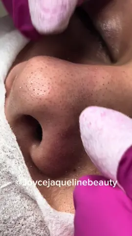 Um narizinho ficando limpinho 😮‍💨 #satisfyingvideo #fy #foryoupage #pimple #tirandocravo #esteticafacial 