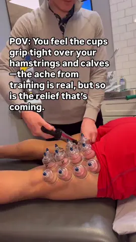 🏆 Cupping Therapy for Hamstrings and Calves ▪️ What’s happening: Tough workouts can leave your legs heavy and muscles locked up. Cupping draws in blood and oxygen, releasing tension in the fascia and breaking up adhesions. ▪️ Body benefits: With increased circulation and muscle release, you’ll recover faster, move better, and reduce the risk of injury. ▪️ The result: As the cups come off, the stiffness melts away—leaving your legs lighter, stronger, and ready for whatever’s next. #ChicagoChiropractor #SportsChiropractor #RoscoeVillage #CuppingTherapy #HamstringRecovery #CalfRelief #SportsPerformance #PainRelief #ChiropracticCare #MobilityTraining #ActiveRecovery #DrKyleRoss #DrKaitHoff #DrAdamAltman