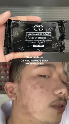#duet with @Kuamelch #cbniacinamidesoapformen CB NIACINAMIDE SOAP 10X WHITENING #niacinamide #soap #soapasmr #duet #pimple #acnetreatment 