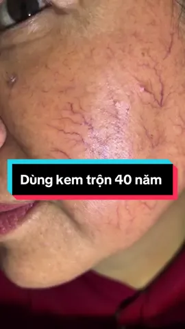 Dùng kem trộn từ 15 tuổi đến 55 tuổi. Các bạn cùng nhìn xem hậu quả nhé. Hãy là người lựa chọn thông minh khi chọn các sản phẩm an toàn trên da của mình các bạn nhé ! #bschumui #mụn #kemtron 