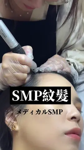 有髮際線變高或是高額頭的困擾嗎 那你一定要知道SMP紋髮 這項技術可以立即性的讓外觀改善 且幾乎算是永久的的效果 CP值很高的一項技術喔！ 💎SMP紋髮的特色： ✅效果即時可見： 模擬出自然的毛囊外觀。 幾次療程後，你的髮際線將看起來更加濃密， 效果立竿見影。 ✅無需恢復期： 這是一種非侵入性的技術，不需要恢復時間， 也沒有手術風險。 ✅天生毛囊數不多者： 本來毛囊就少，導致髮量稀疏而頭皮明顯， 可以透過紋髮讓視覺效果看起來變茂密 留言預約免費諮詢， 我們將為你量身定制最適合的療程建議唷！ 歡迎 賴 線上預約：@575oitoh #SMP紋髮 #smp #科技育髮 #外泌體 #外泌體育髮 #生髮 #落髮 #禿頭 #yuname優奈美頭皮美學管理 #新北育髮 #大安區育髮 #三重紋髮 #蘆洲紋髮 #大安區紋髮 #新北紋髮 #三重育髮 #蘆洲育髮 #中正區育髮 #中正區紋髮 #台北市紋髮 #台北市育髮 #メディカルsmp #smp #テクノロジー育毛 #エクソソーム #エクソソーム育毛 #発毛 #脱毛 #禿頭 #yuname優奈美頭皮美学管理