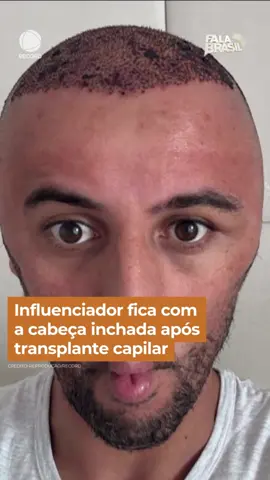 Um influenciador digital deve estar de cabeça quente depois do resultado de uma cirurgia de transplante capilar que não deu muito certo. #FalaBrasil