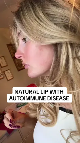 Natural lip filler with an autoimmune disease thank you @Taylor Szupiany, PA-C @CUPID LIPS ® they do the MOST NATURAL LIPS you barley can tell