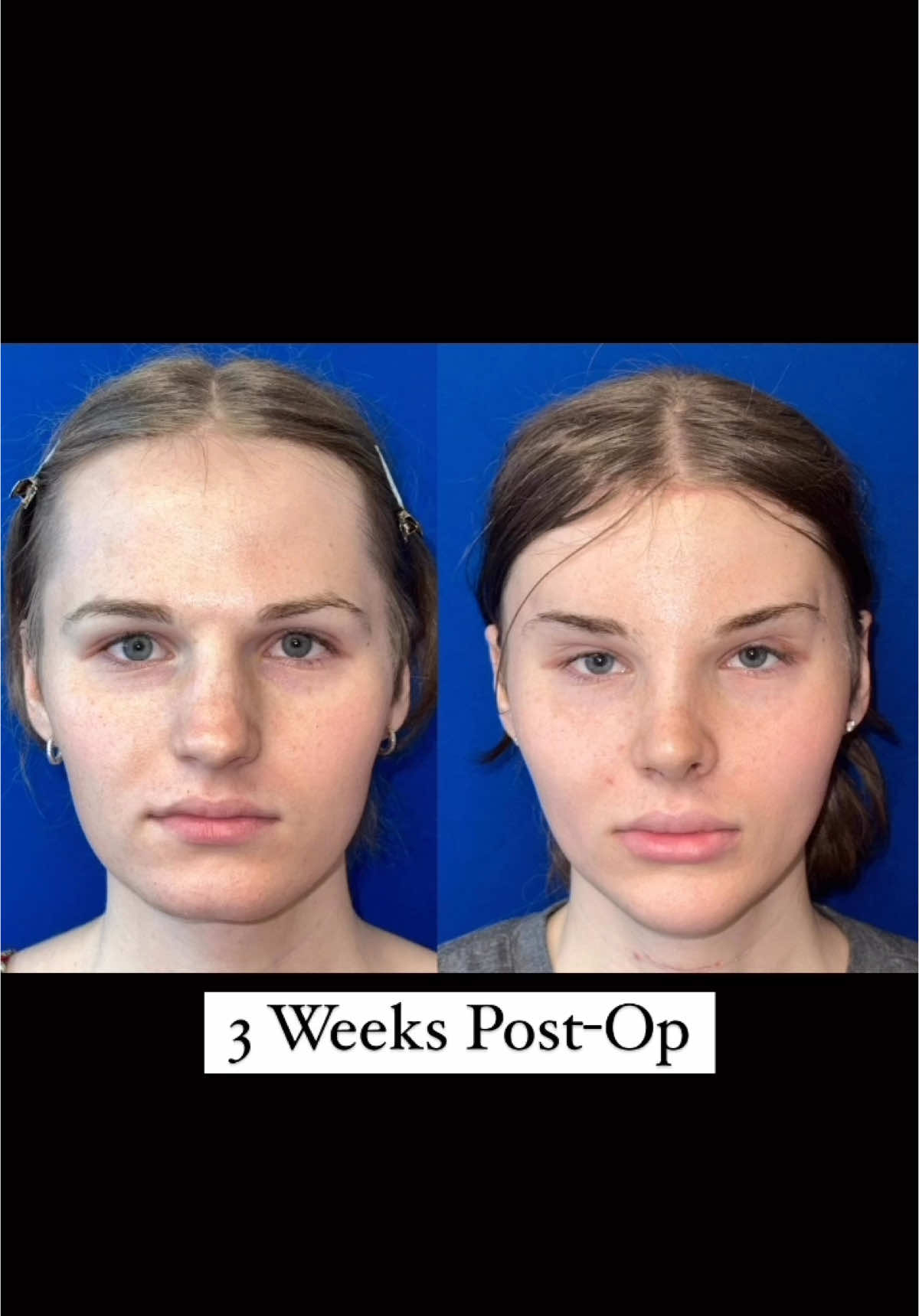 Facial Feminization 3 Weeks Post-Op🔥 #FacialFeminization#FFS#Transformation#BeautyJourney #PlasticSurgery#BeforeAndAfter #SelfLove #Confidence#TransFormation#SurgeryJourney#FeminineFeatures#BeautyEnhancement#Rhinoplasty#NoseJob#DeviatedSeptum#Septoplasty#NoseSurgery#RhinoplastyJourney #FacialSurgery#CosmeticSurgery#NoseTransformation#BeforeAndAfter#genioplasty#eyebrowlift#fatgrafting#hairline#advancement#forhead#orbital#contouring#drfahradyan
