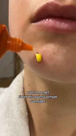 I’ll update you tomorrow 🤍 #pimple #acne #acnetips #clearskin #acnetreatment 