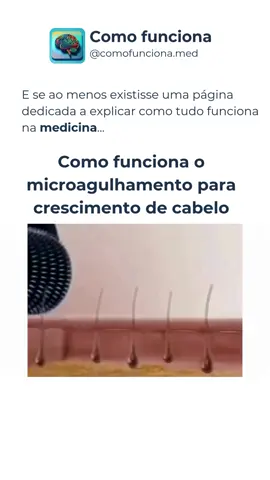 Nos siga (@comofunciona.med) para aprender como as coisas funcionam na medicina📍 !? Como funciona o microagulhamento para crescimento de cabelo #tiktokbrasil #comofunciona #viralizou #brasil