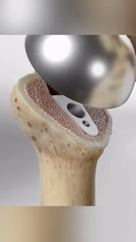 Total shoulder replacement (3D Animation) Did you know most modern shoulder implants last 20 years or more? #shoulderpain #shoulderpainrelief #replacement #shoulderreplacement #3danimation #medicaleducation #medicalanimation #3danimationsurgery #medicaltiktok