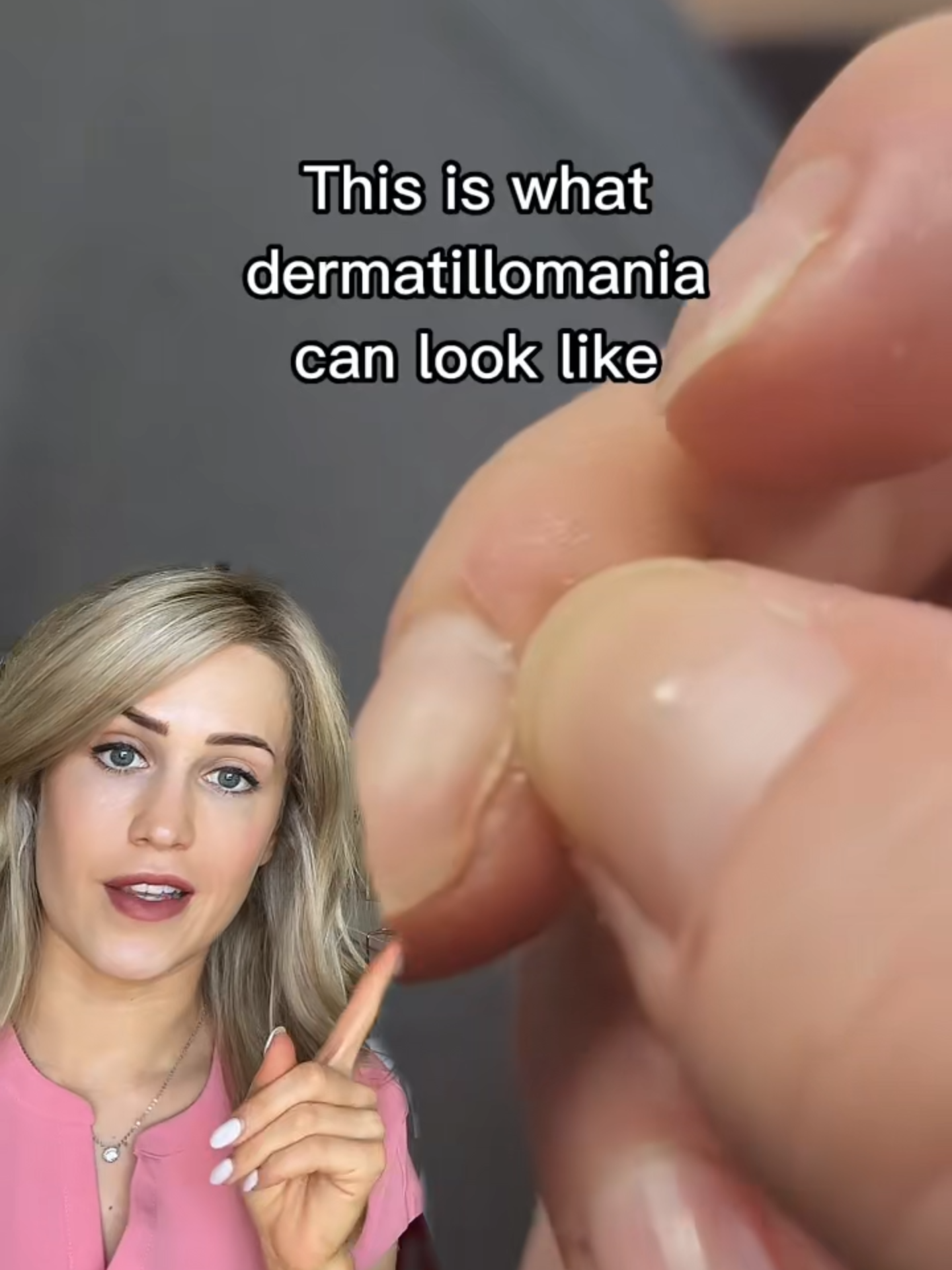 It's more common than you might think #dermatillomania #skinpicking #skin #health
