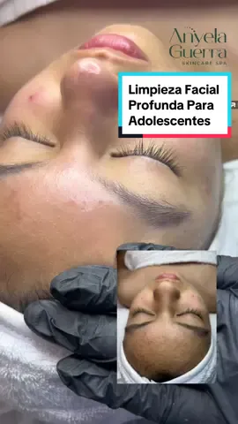 ¿Piel grasa o con imperfecciones? La adolescencia puede ser complicada para tu piel, ¡pero no te preocupes! 💆‍♀️ Te traigo una limpieza facial profunda diseñada especialmente para jóvenes. Mantén tu piel fresca, limpia y libre de impurezas con la técnica de Anyela Guerra, tu cosmiatra de confianza. 🌸 Con mi tratamiento, reducimos el exceso de grasa, eliminamos células muertas y prevenimos esos molestos brotes de acné. 💧 Porque una piel saludable es clave para sentirse bien desde dentro y por fuera. 💖 ¡No esperes más! Agenda tu cita y dale a tu piel el cuidado que merece. 🌿✨ #LimpiezaFacial #PielAdolescente #CuidadoDeLaPiel #AcnéJuvenil #PielGrasa #Cosmiatra #SkincareRutina #AnyelaGuerraSkinCare #BellezaNatural #Adolescentes #limapueblolibre #ComedonesFuera #CuidadoDeLaPiel #anyelaguerraskincarespa #cosmiatra #fyp #viral_video 