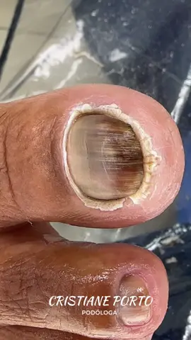 🤤| VÍDEO SATISFATÓRIO PARA DORMIR. . #podologia #satisfatório #peeling #viral #satisfyingvideo 