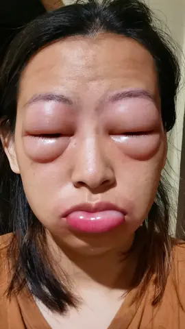 Ada yang sama alergi obat?? #alergi #alergiobat #matabengkak 