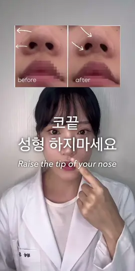 ☑️ 코끝(콧날개) 높이기  코끝은 코중격 내림근이 뭉치면 코끝의 연골과 피하지방이 같이 쳐지게 되요. 그래서 그 경계선인 인중을 같이 늘려줘야 수축된 근육을 느슨하게 해주면서  위로 올리게 할수있어요🙂 결국엔 엉켜있는 근막을 풀어주고 원래대로 돌려주는 것이 최종 역할이에요🙂 📌 코끝이 쳐져있다고 해서 코끝만 만지는게 아니라 주변 부위를 만져줘야 하는게 포인트 입니다. - Raise the tip of the nose At the tip of the nose, when the nasal septum muscles clump together, the cartilage and subcutaneous fat at the tip of the nose hit together. So, you need to stretch your philtrum together to loosen your contracted muscles I can make it go up 🙂 In the end, the final role is to release the tangled fascia and return it to its original state 🙂 📌 Just because the tip of your nose is drooping, you need to touch the surrounding area, not just the tip of your nose.