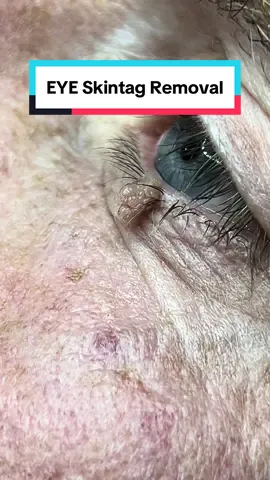 Today I removed this annoying skin tag from under this chaps eye sensitive he was able to tolerate the discomfort which was only for a minute or so and the tag will completely be gone within the next six weeks. Looking forward to seeing this once it’s all healed up in a couple of months #skintag #mole #wart #moleremoval #skintagremoval #kettering@The Daylight Company 