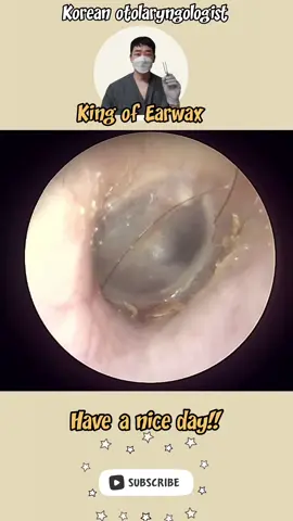 @귀지형 #귀지#귀지제거 #귀파기 #귀파기asmr  #귀청소 #이비인후과 #earwax #earwaxremoval  #asmr #ENT #ENTdoctor