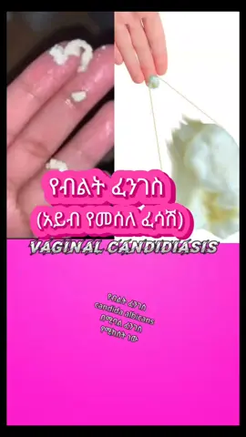 abnormal whitsh discharge | አይብ የመሰለ ፈሳሽ #creatorsearchinsights #momtomom #health #femalehealth #abnormaldischarge #ethiopian_tik_tok #habeshatiktok 