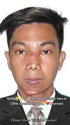 Ellowe Alviso 💔 Face and Nose 👃 Enhancedment Rhinoplasty Reconstructive Surgery #disaster #botched  #botchedsurgery #botchednose #nose  #facedisaster #face #disaster #licensedesthetician  #licensedcosmetologist #clinic #quezoncity #licensed #doctor  #plasticsurgery #History  #story #skingrafting  #rhinoplasty   This is my Story About my Nose 👃 #worst #failed #wrongturn #horror #creepy #ellowe  #ellowealviso  #ellowealvisoofficial  #ellowealvisostory #mystory   This Video For #awarness #share #foryoupage #viral #photo #beforeandafter #before #after #now #creepy #like #pain #baddreams #pray #help #doctor #clinic #halloween #breakingnews #enhancement #surgery #operation #sharingmystory #watch 
