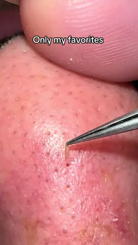 I’m stil working on repairing his barrier. Please leave me tips ❤️#skincare #relaxingvideos #pimplepopping #skin #tweezers #pimple #satisfyingvideo #pimplepopper #skincareroutine #skin 