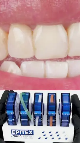 Use essas lixas para suas interproximais nao pigmentarem!!  Mostrando na pratica como realizar o polimento interproximal. Evitando pigmentação precoce das suas restauraçoes e facetas.  Demonstracao pratica! #resina #dentista #dentistanotiktok #dentistica #dicasodonto #dicaspraticas 