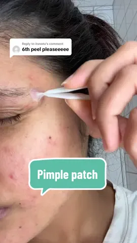 Replying to @itsnotu  Now it’s completely healed✌️✌️  #acne #pimplepatch #pimplepatches #acnepatch #pimplepop #pimpleremover #acneproneskin #acneskin #acnefighter #acnepositivity 