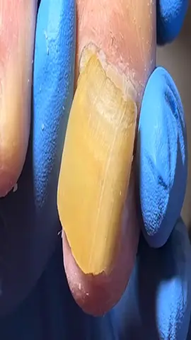 The toenails are affected by fungus and are ingrown#fungus #toenails #nails #fungusnails #fungusnail #nailtutorial