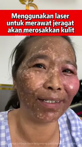 Menggunakan laser untuk merawat jeragat telah merosakkan kulit, menyebabkan kulit merah, terbakar dan kapilari seperti ini 😭😭 #jeragat #melasma #laser