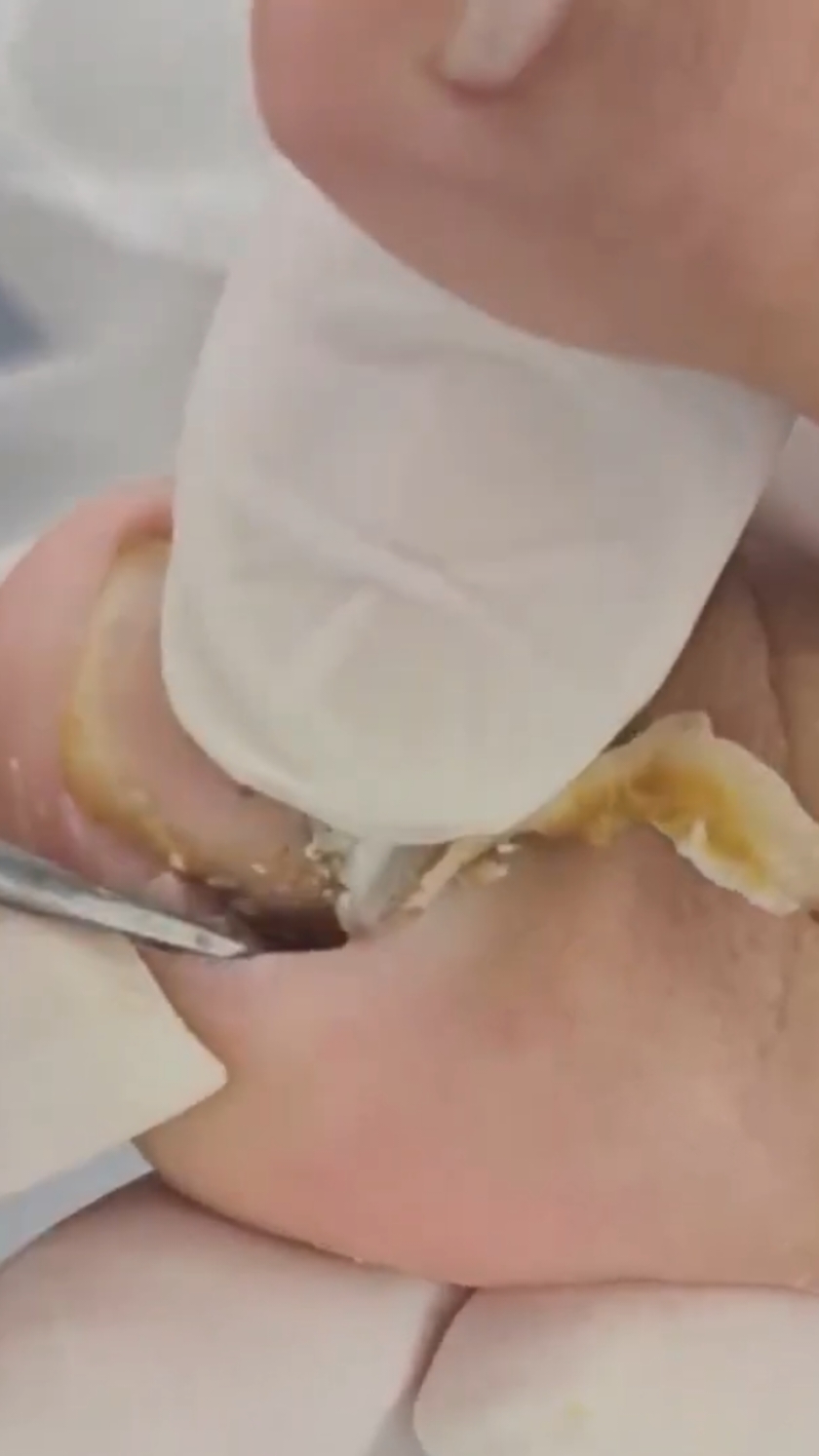 INACREDITÁVEL O QUE SAIU DALI PASSO A PASSO PARA A CURA DAS PELES ONICOFOSE #satisfying #podiatry #podiatrist #footcare 
