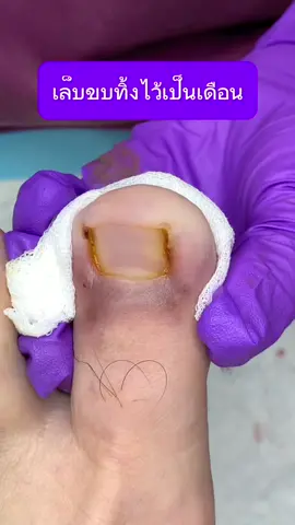 เล็บขบออก เกินต้านมากคะเคสนี้#ingrowntoenail #ตัดเล็บขบ #wefootตัดเล็บขบรักษาเล็บเชื้อรา #เล็บขบหนักมาก #เล็บขบอักเสบ #เล็บขบ #ตัดเล็บขบมียาชา 
