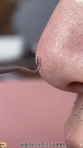 matatanggap na pang patanggal nang whiteheads and blackheads. Click my yellow basket. #acneneedle #whiteheads #blackhead #fyp 