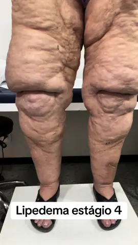 O lipedema é uma doença progressiva, sem cura, porém, com melhora importante com tratamento adequado. Unindo forcas entre cirurgia vascular, endocrino, nutrição, fisiterapia e atividade fisica, conseguimos recultados mais expressivos do que com tratamentos mais invasivos como cirurgias plasticas. Essas ultimas, podem ocorrer, mas apos o tratamento clinico.#varizes #lipedema #cirurgiaplastica #endocrinologia #nutricao #fisioterapia #vascular #inflamação #gordura 